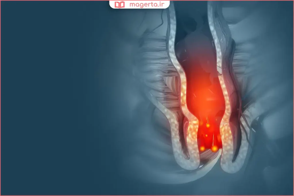 درد و سوزش ناحیه مقعد هنگام دفع مدفوع