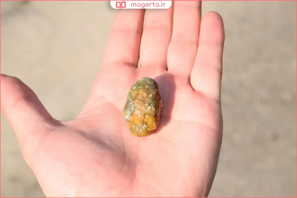 مشاهده ذرات ریز یا سنگ‌مانند در مدفوع