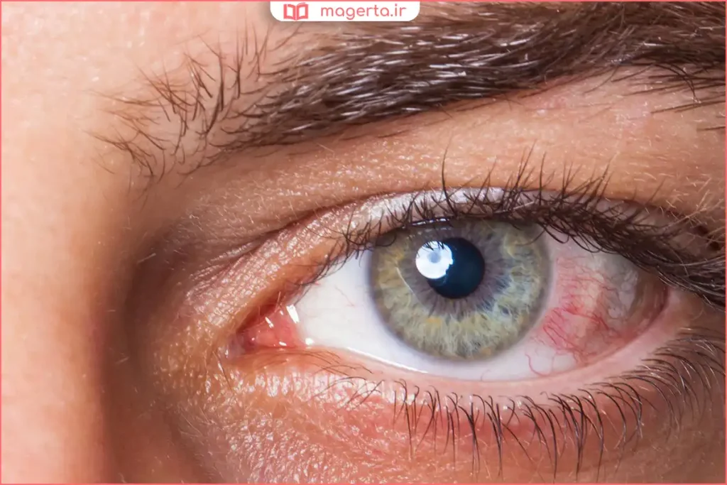 معاینه چشم توسط پزشک برای بررسی افزایش فشار داخل چشم