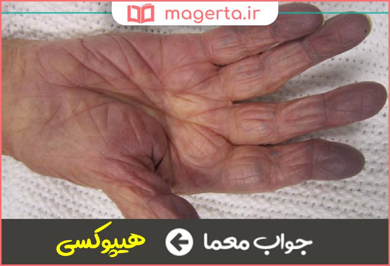 جواب معما کاهش اکسیژن رسانی به بافت ها در جدول