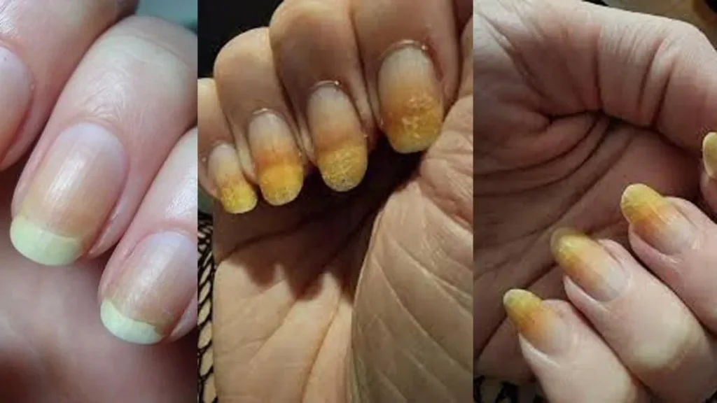 علت زردی ناخن
