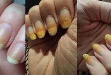 علت زردی ناخن