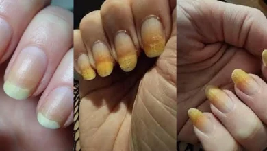 علت زردی ناخن