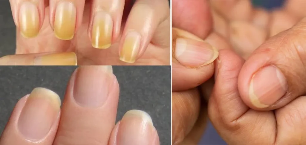 زردی ناخن