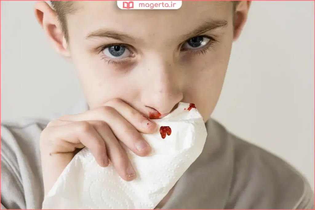 خونریزی از بینی به دلیل خشکی مخاط داخلی بینی