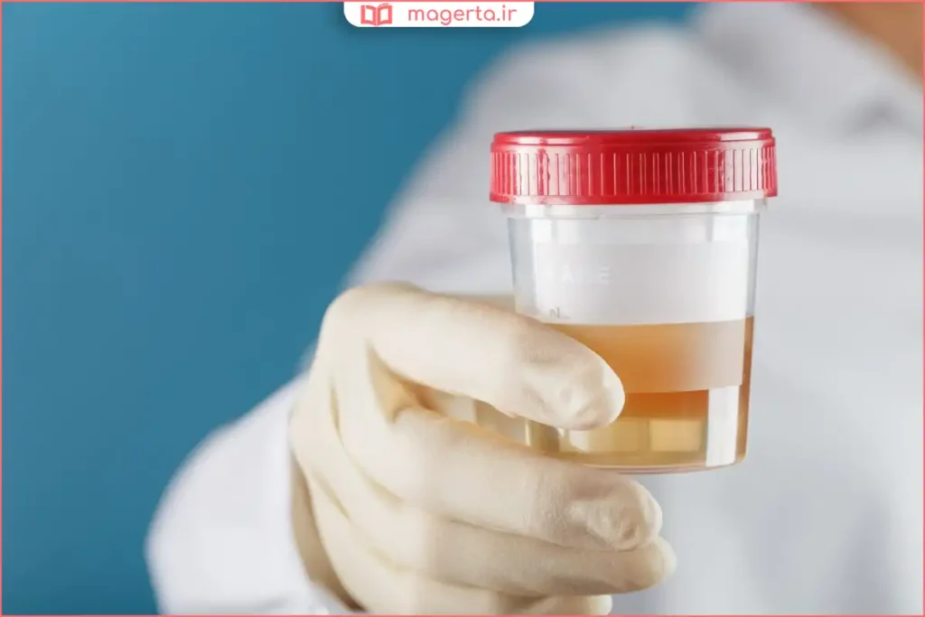 مشاهده خون در ادرار داخل توالت یا ظرف آزمایش