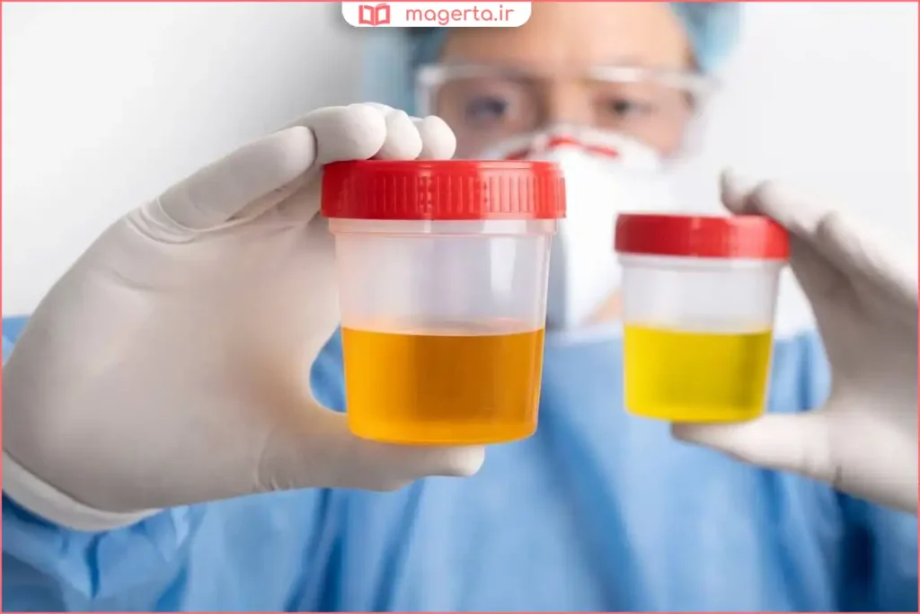 نمونه ادرار حاوی خون قابل مشاهده با چشم