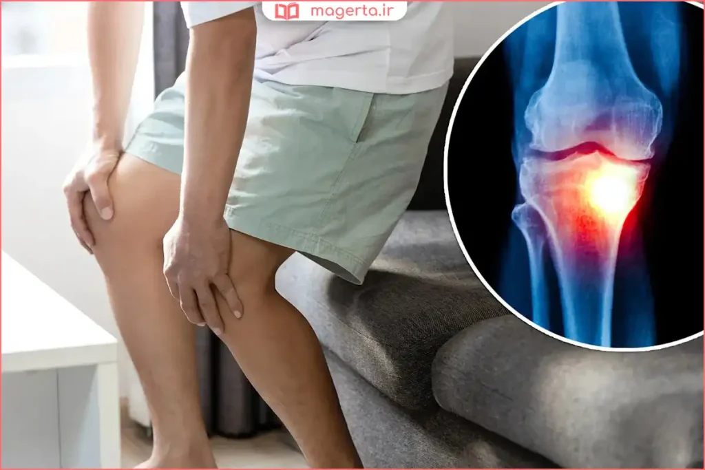 درد زانو تا ساق پا هنگام راه رفتن یا ایستادن طولانی