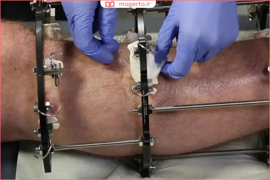 کاربرد پلاتین در ایمپلنتها و ابزارهای پزشکی سازگار با بدن