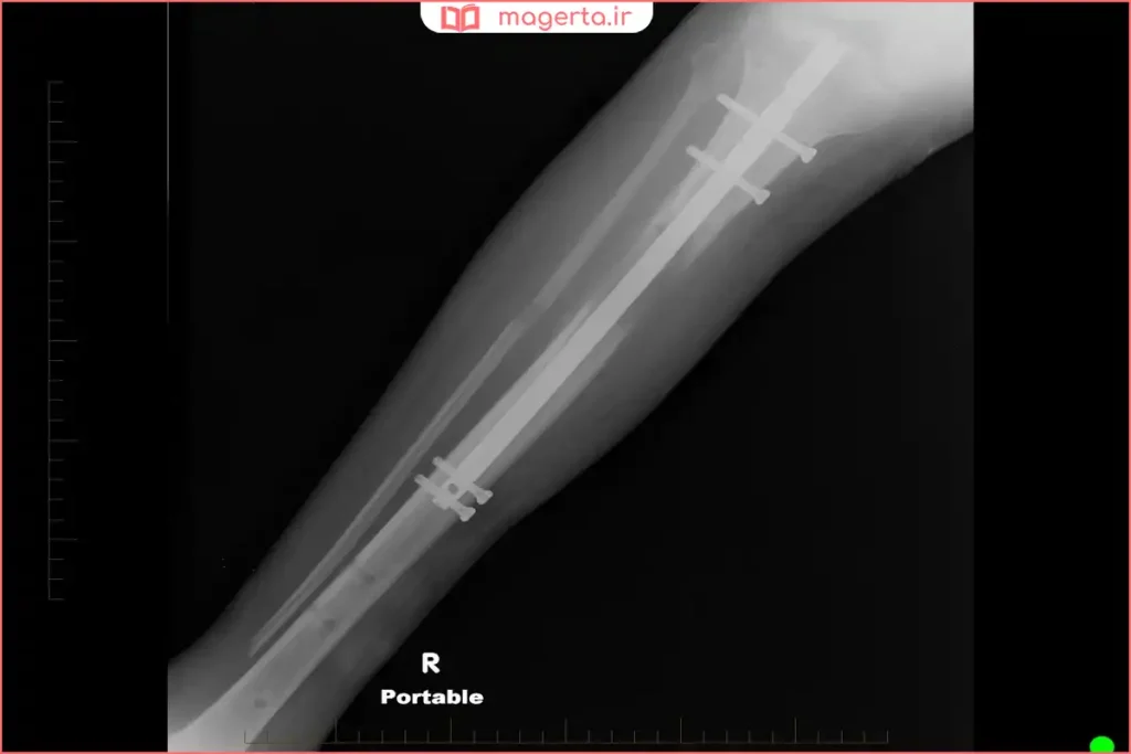 حضور فلز پلاتین در ساخت قطعات پزشکی مقاوم در بدن