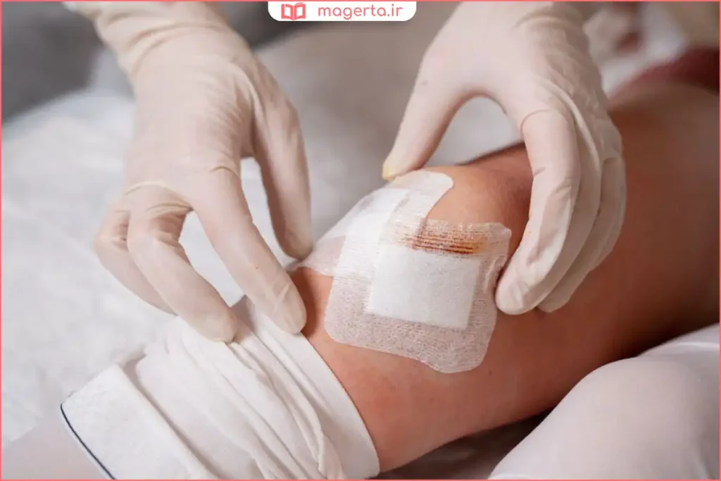 ترشح مایع شفاف از محل بخیه زخم پس از جراحی