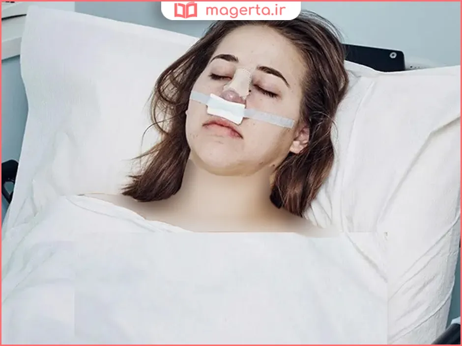 چگونه بعد از عمل بینی بخوابیم