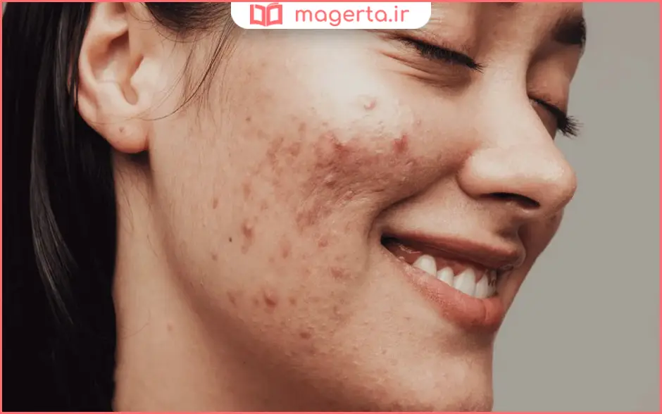 از بین بردن لک صورت در خانه