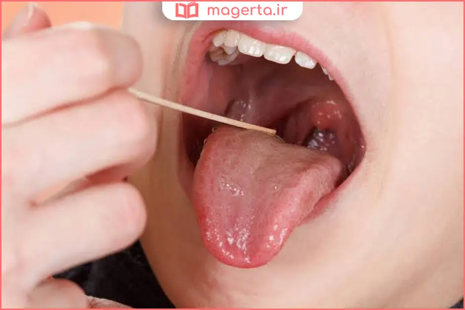علائم نیاز به عمل لوزه
