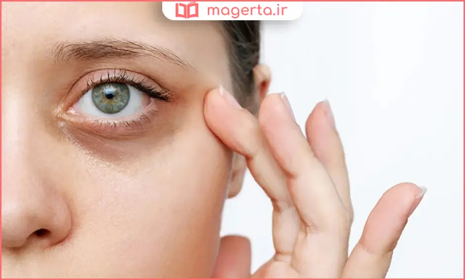 چرا دچار سیاهی زیر چشم می‌شویم؟ 