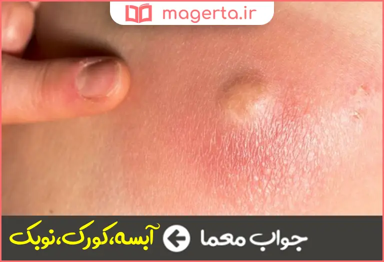 جواب معما دمل چرکی در جدول