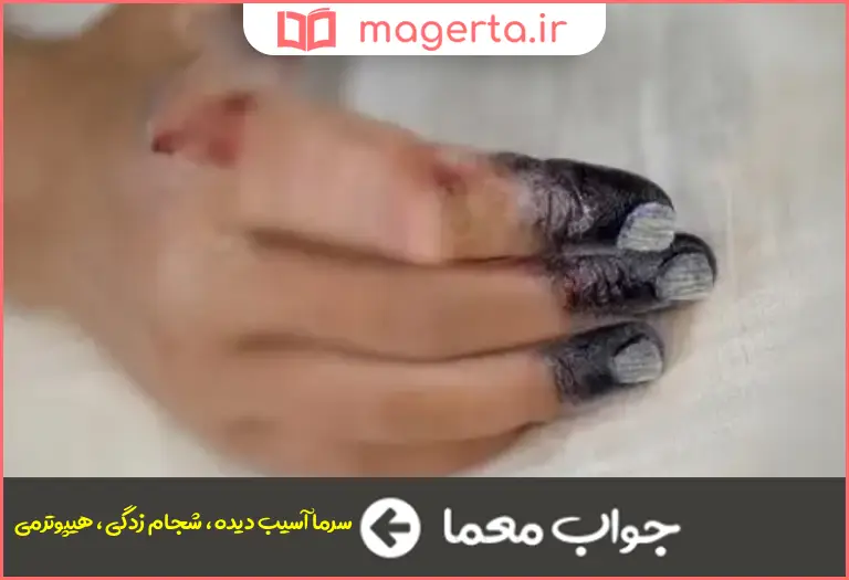 جواب معما سرمازدگی در جدول